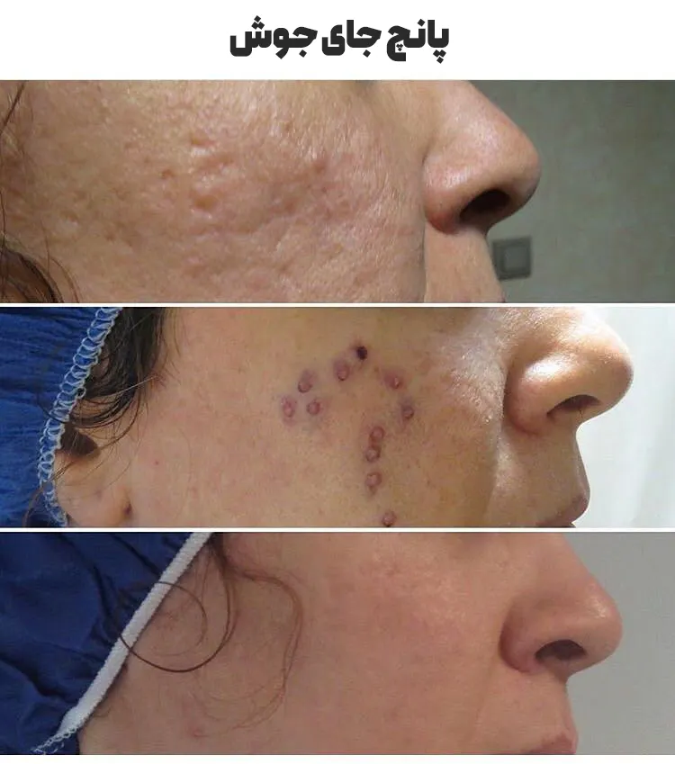 پانچ جای جوش