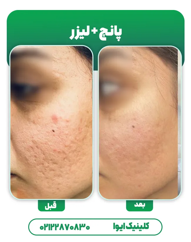 پانچ جای جوش