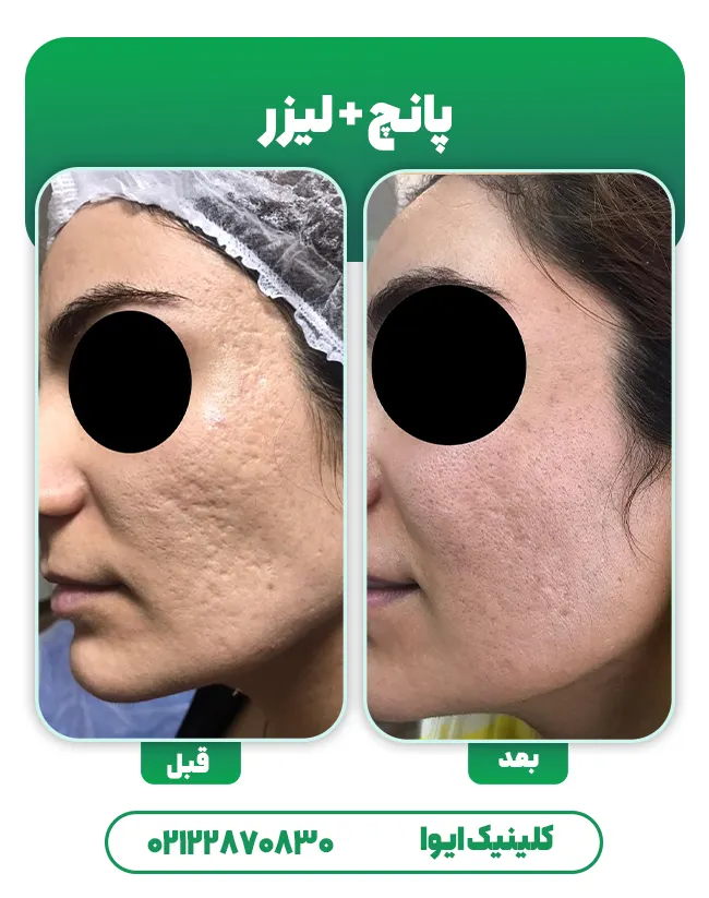 پانچ اسکار آکنه