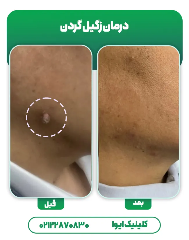 درمان زگیل گردن