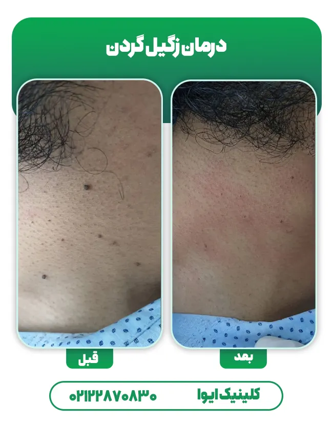 درمان زگیل گردن