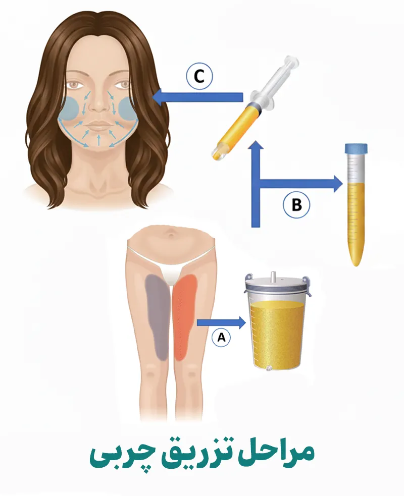 مراحل تزریق چربی