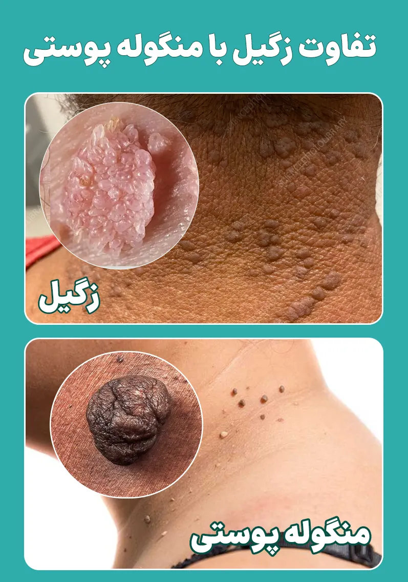 تفاوت زگیل گردن با منگوله پوستی