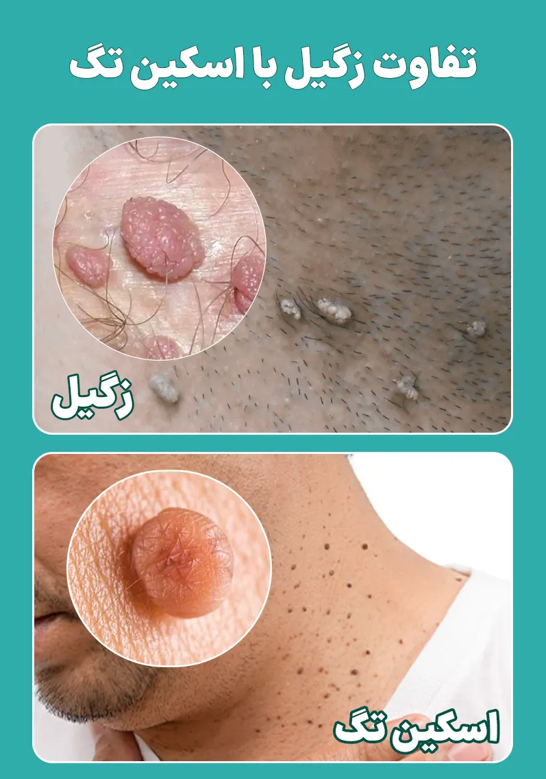 تفاوت زگیل گردن با اسکین تگ