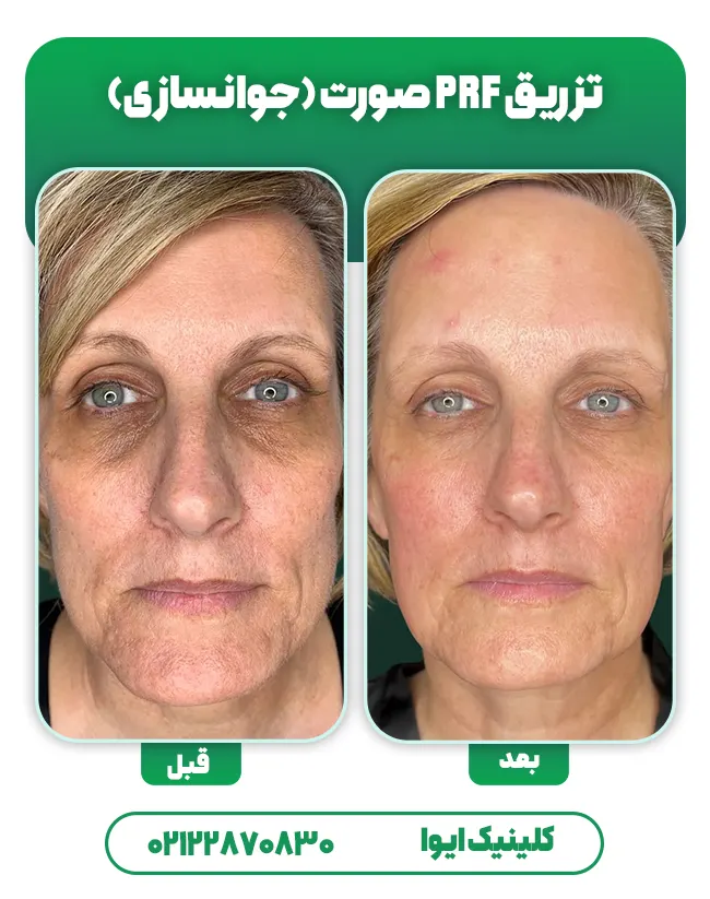 جوانسازی با PRF