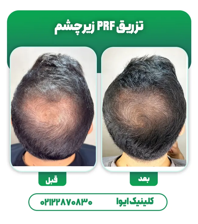 درمان ریزش مو با PRF