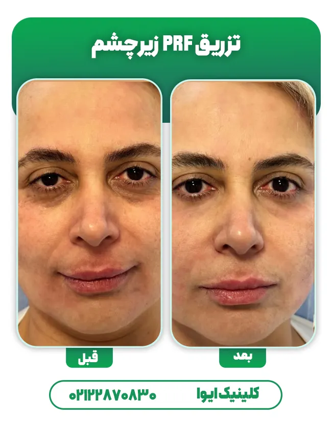 تیرگی زیر چشم با PRF