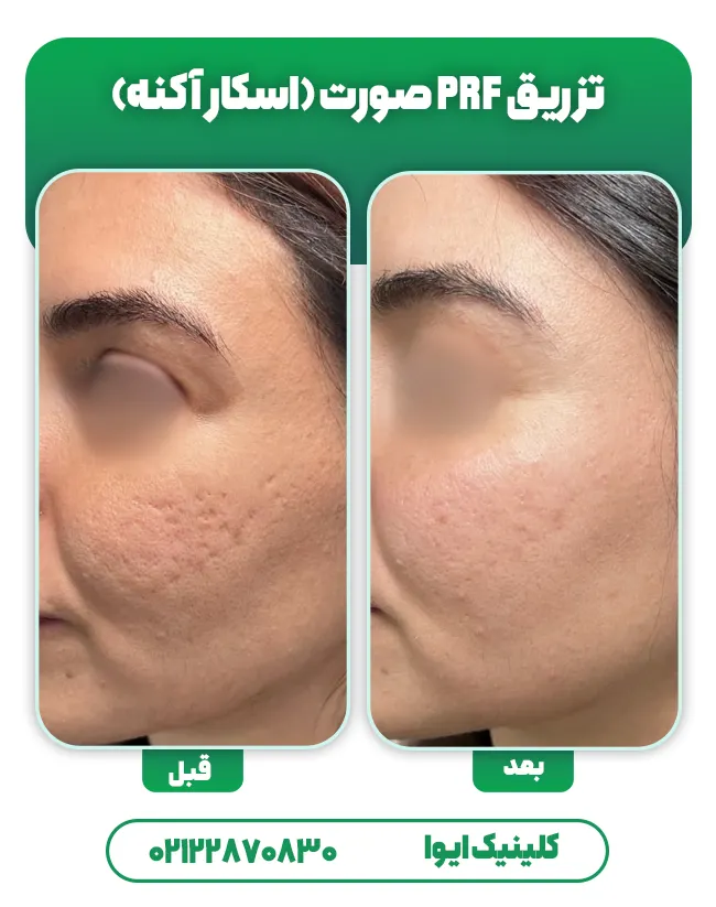 درمان اسکار با PRF