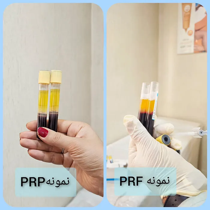 تفاوت‌های بین PRP و PRF