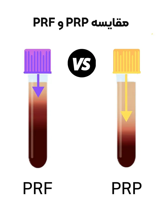 تفاوت‌های بین PRP و PRF
