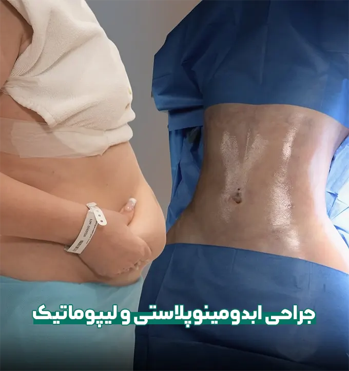 ليپوماتیک و ابدومینوپلاستی