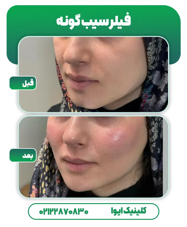 فیلر سیب گونه