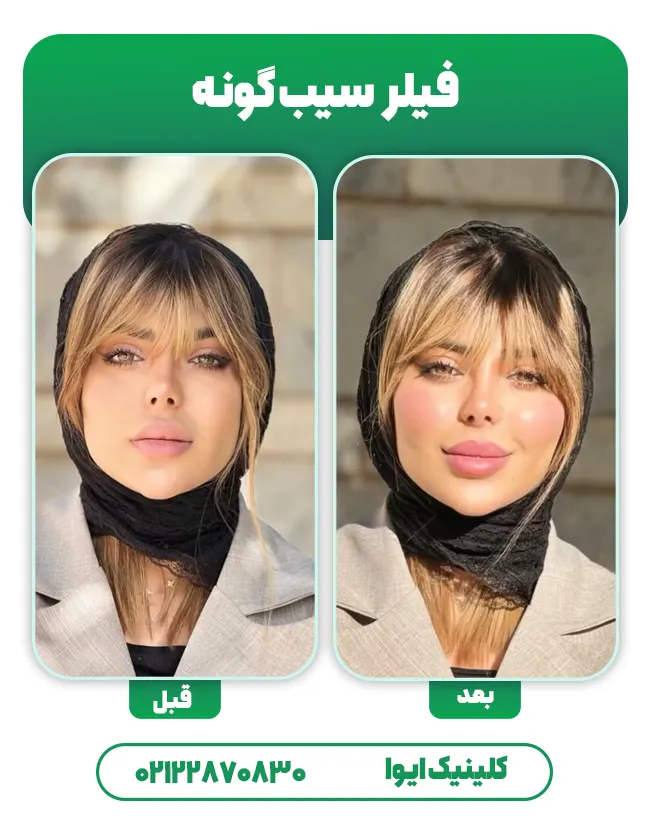 فیلر سیب گونه