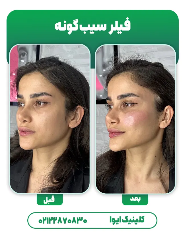 فیلر سیب گونه