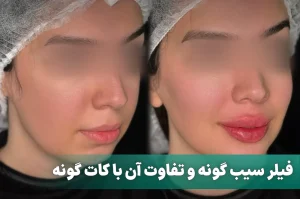 فیلر سیب گونه و تفاوت آن با کات گونه