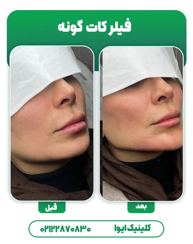 فیلر کات گونه