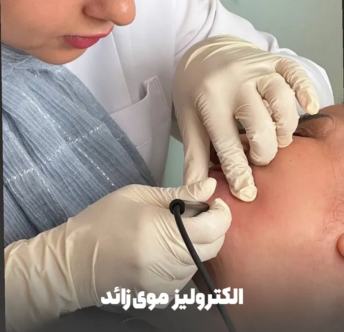 الکترولیز موی زائد