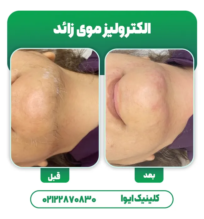 الکترولیز موی زائد