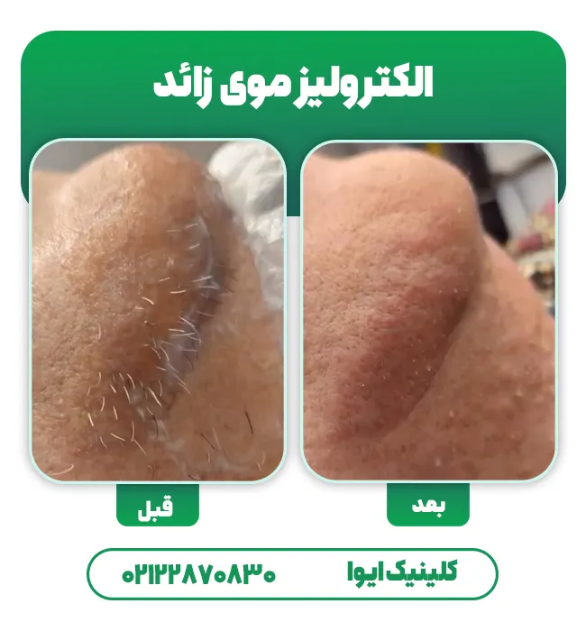 الکترولیز موی زائد