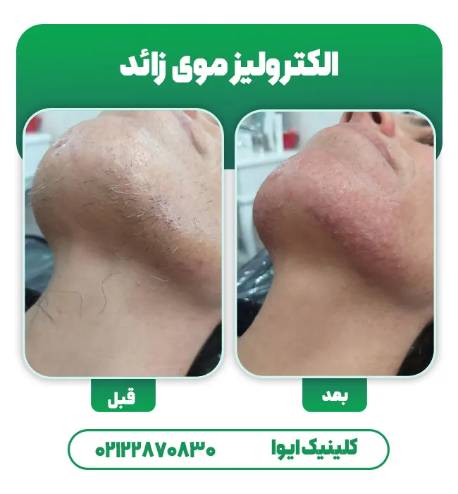 الکترولیز موی زائد
