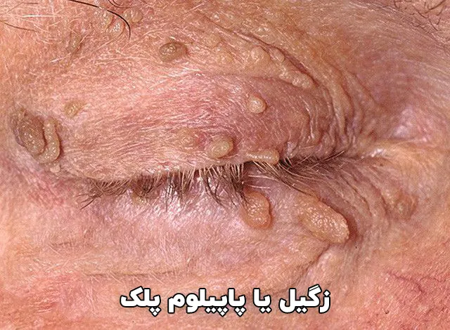 زگیل یا پاپیلوم روی پلک