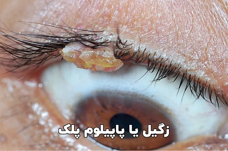 زگیل پلک