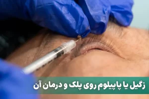 زگیل یا پاپیلوم روی پلک و درمان آن
