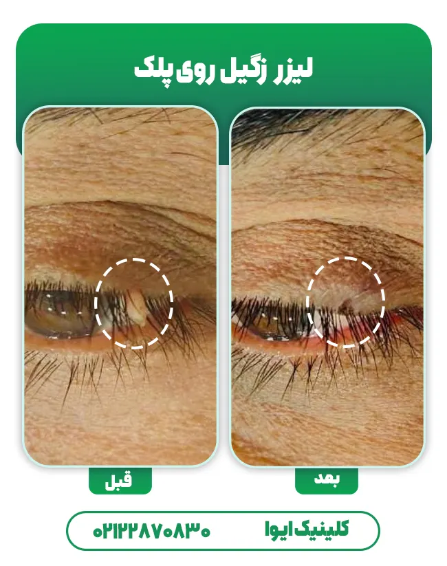 درمان زگیل پلک