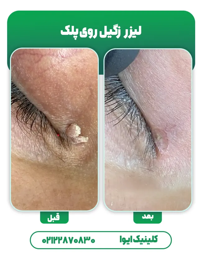 درمان زگیل پلک