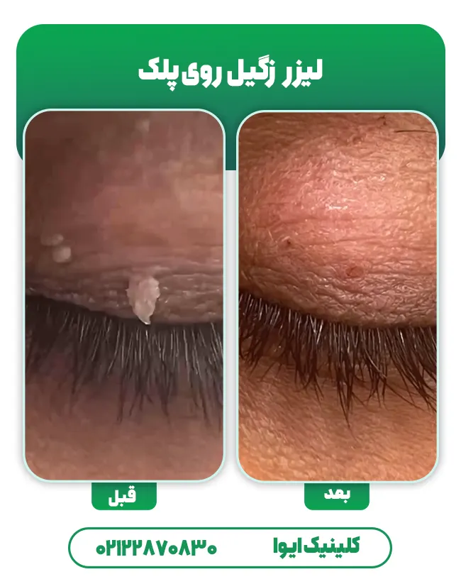 درمان زگیل پلک