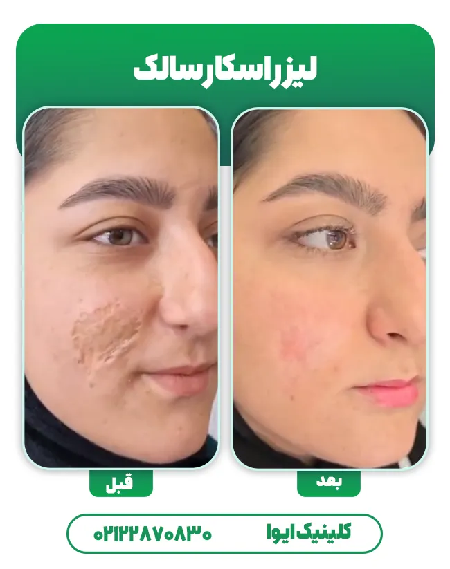 لیزر اسکار سالک