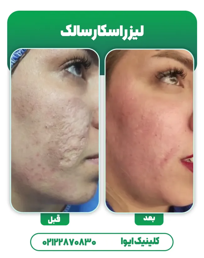 لیزر اسکار سالک