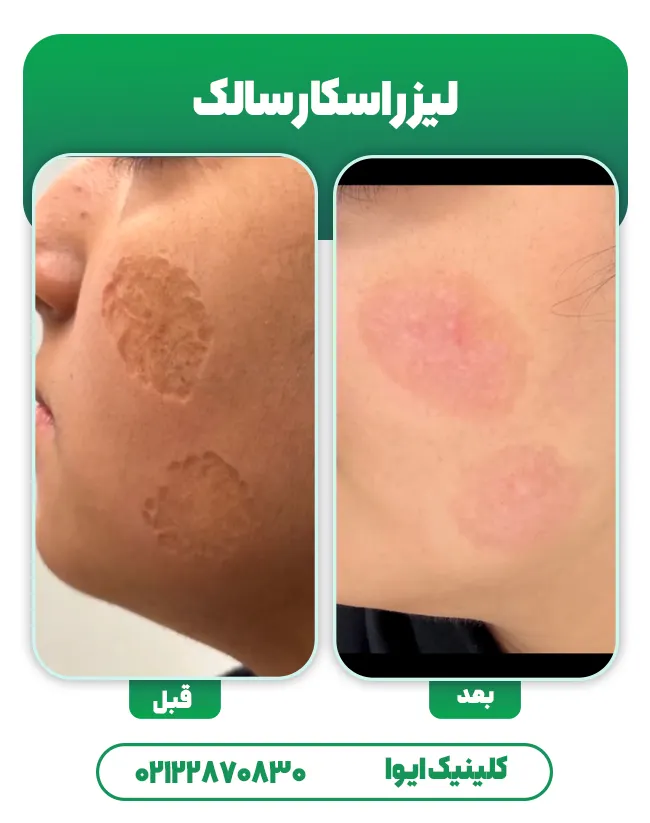 لیزر اسکار سالک