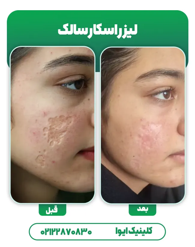 لیزر اسکار سالک