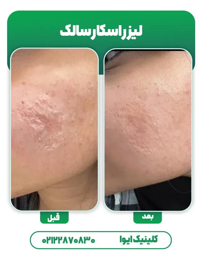 لیزر اسکار سالک