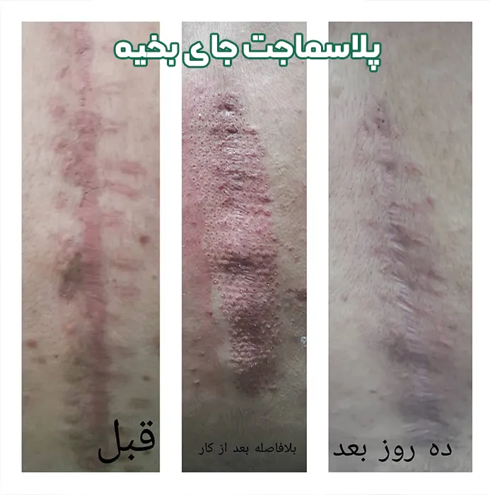 پلاسماجت جای بخیه