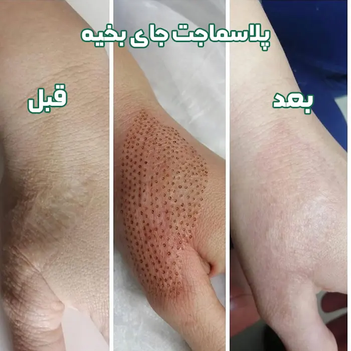 پلاسماجت جای بخیه