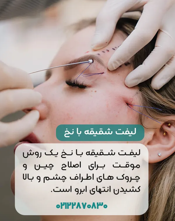 لیفت شقیقه با نخ