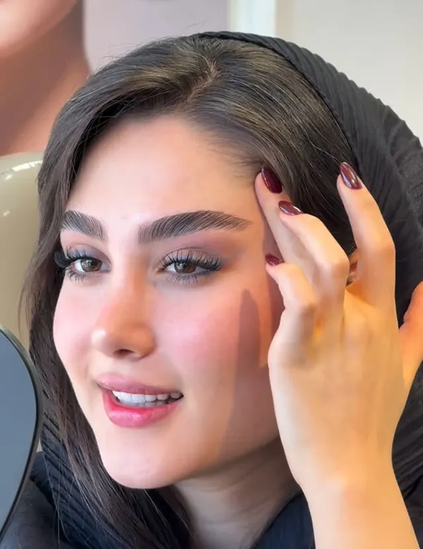 لیفت شقیقه با نخ