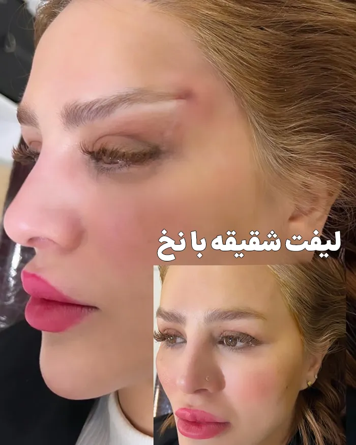 لیفت شقیقه با نخ