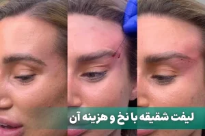 لیفت شقیقه با نخ