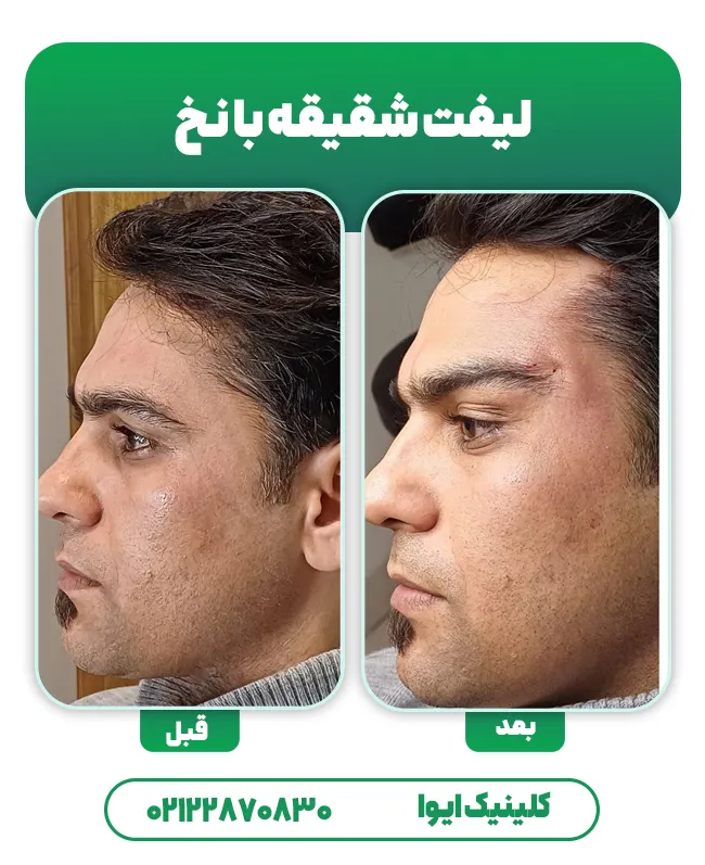 لیفت شقیقه با نخ