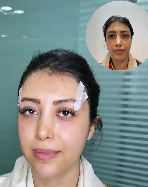 لیفت شقیقه با نخ