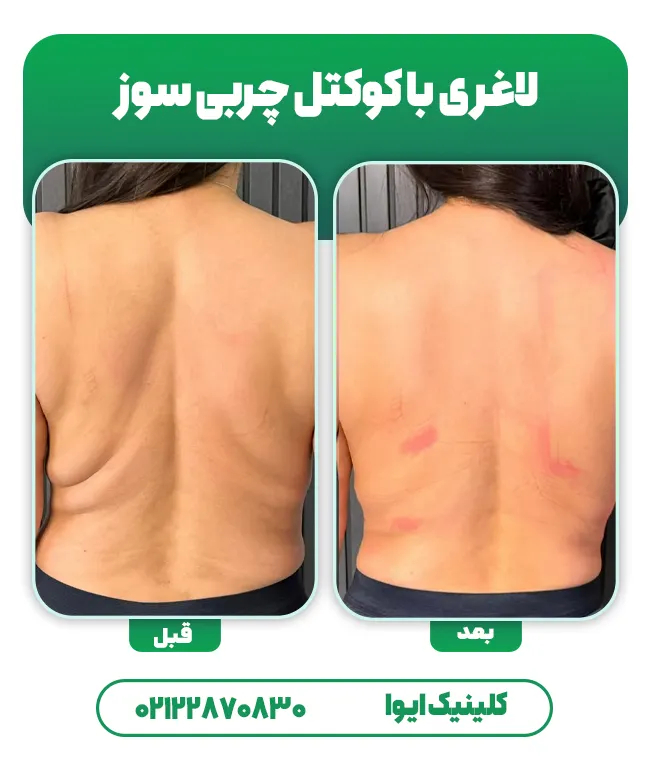 لاغری با کوکتل فیوژن