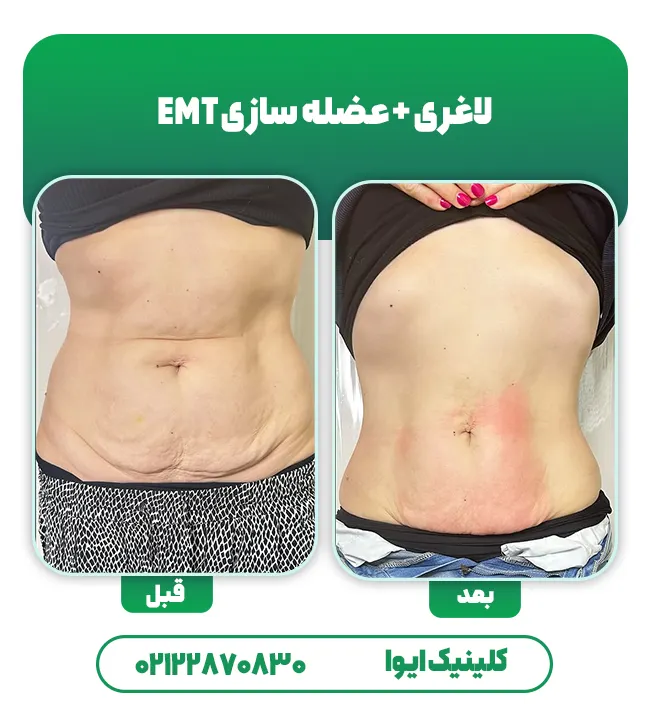 لاغری و عضله سازی با EMT