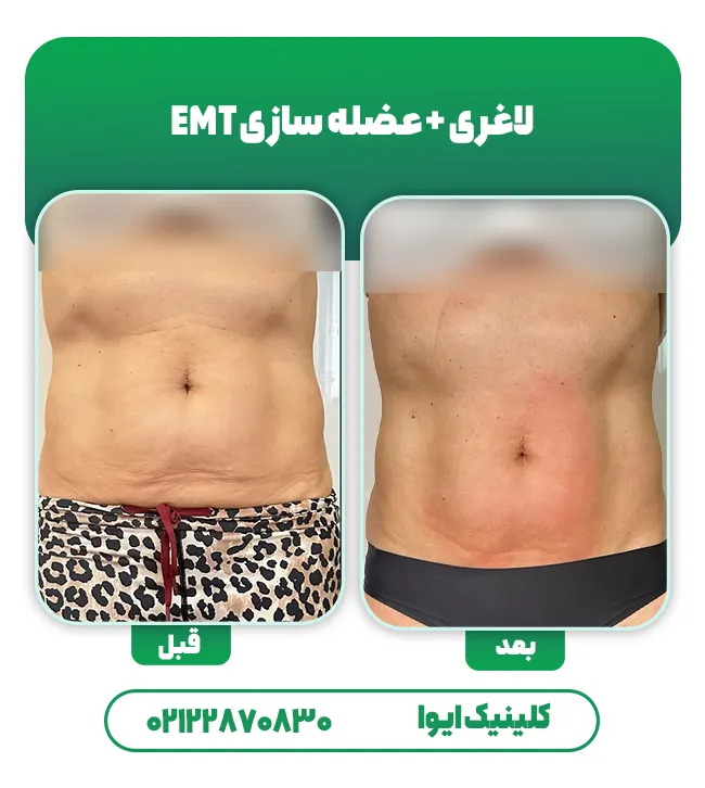 لاغری و عضله سازی با EMT