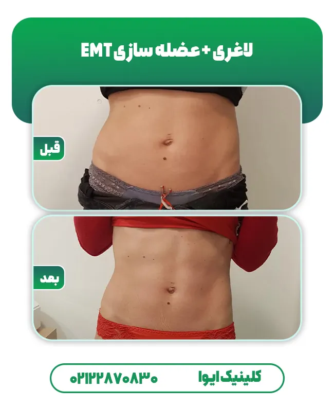 لاغری و عضله سازی با EMT