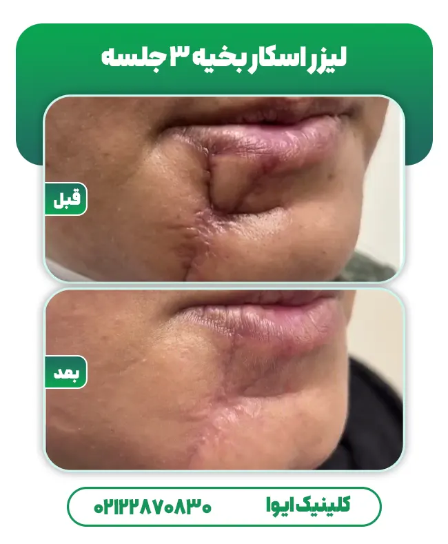 لیزر جای بخیه