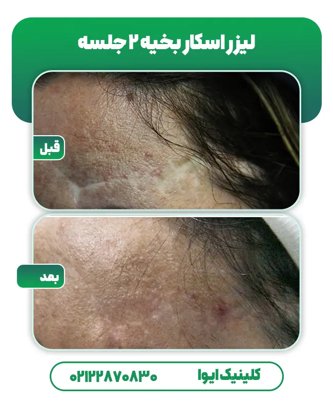 لیزر جای بخیه