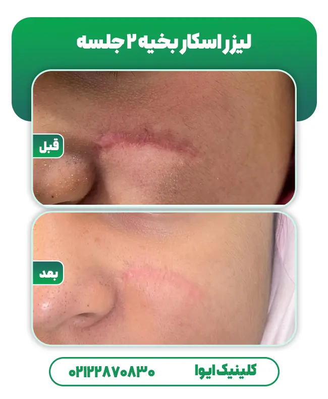 لیزر اسکار جای بخیه